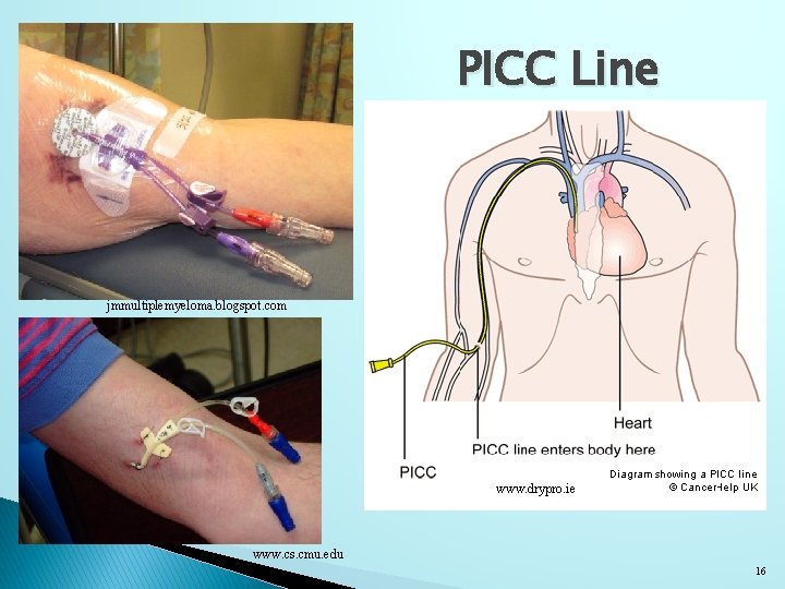 PICC Line jmmultiplemyeloma. blogspot. com www. drypro. ie www. cs. cmu. edu 16 