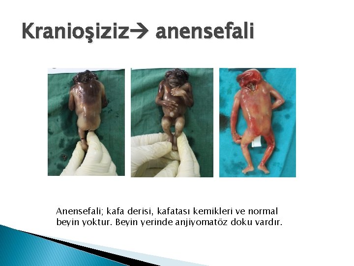 Kranioşiziz anensefali Anensefali; kafa derisi, kafatası kemikleri ve normal beyin yoktur. Beyin yerinde anjiyomatöz