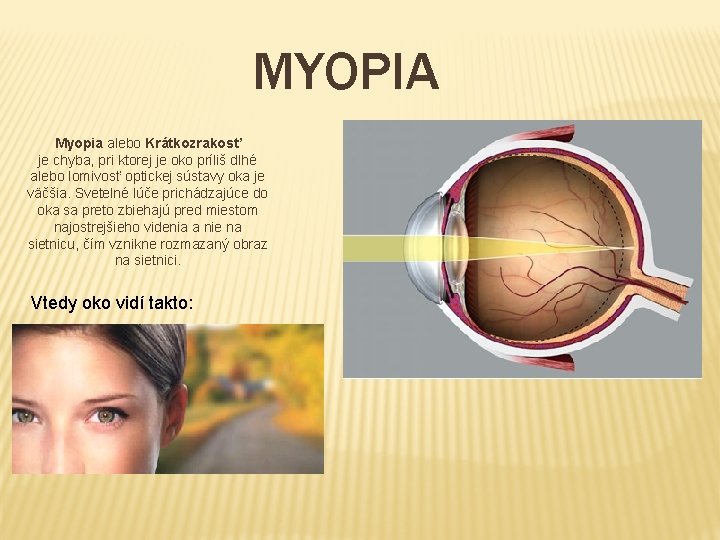 a myopia oka)