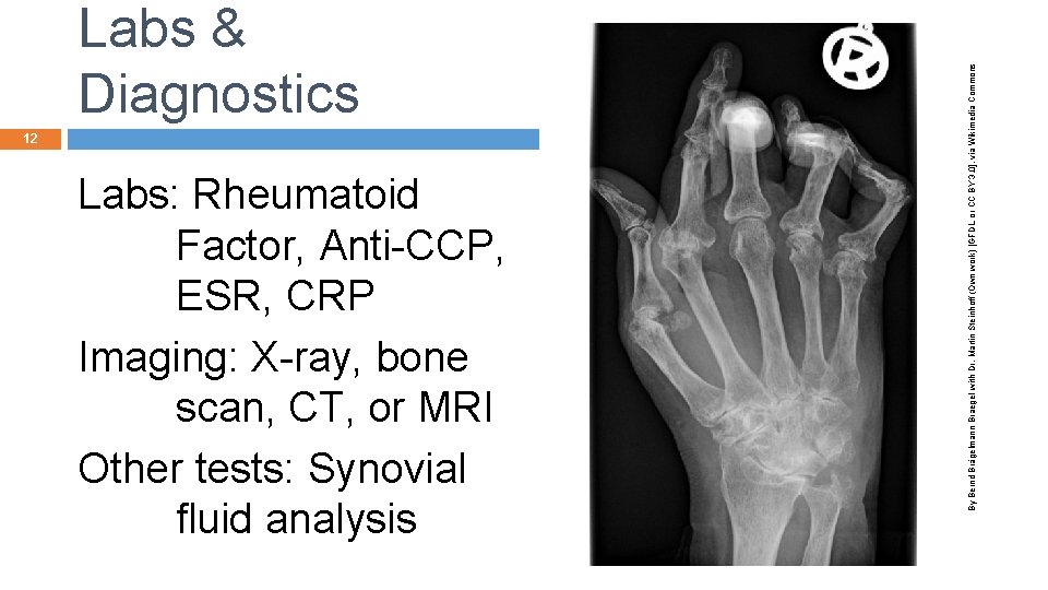 12 Labs: Rheumatoid Factor, Anti-CCP, ESR, CRP Imaging: X-ray, bone scan, CT, or MRI