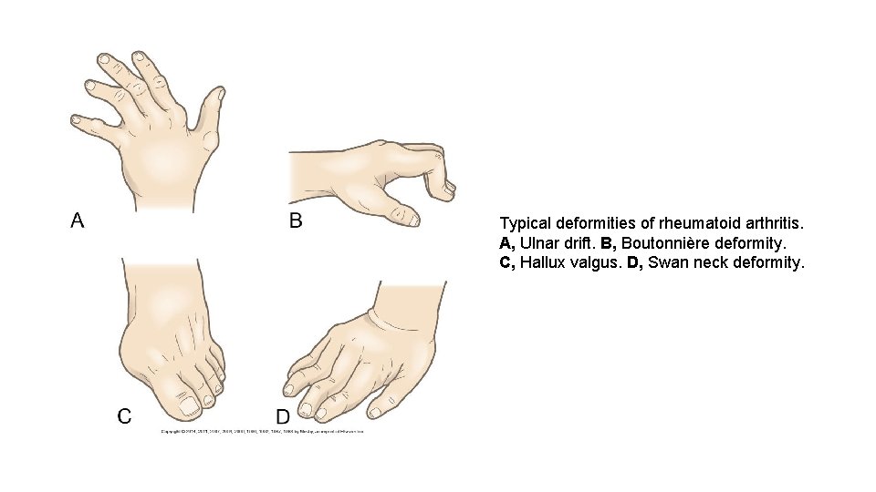Typical deformities of rheumatoid arthritis. A, Ulnar drift. B, Boutonnière deformity. C, Hallux valgus.