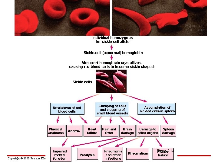 Individual homozygous for sickle-cell allele Sickle-cell (abnormal) hemoglobin Abnormal hemoglobin crystallizes, causing red blood