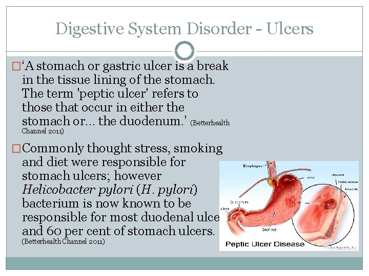 Digestive System Disorder - Ulcers �‘A stomach or gastric ulcer is a break in