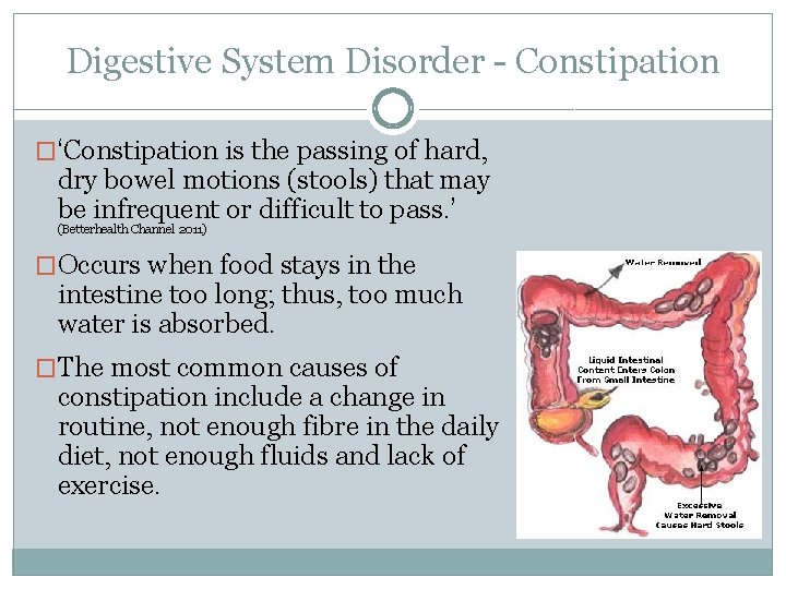 Digestive System Disorder - Constipation �‘Constipation is the passing of hard, dry bowel motions