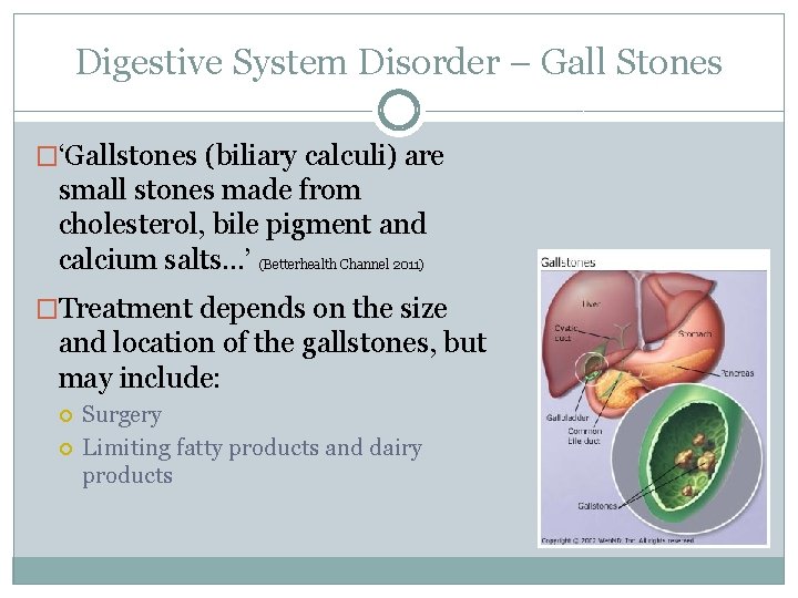 Digestive System Disorder – Gall Stones �‘Gallstones (biliary calculi) are small stones made from