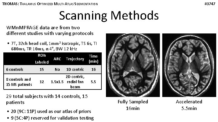 THOMAS: THALAMUS OPTIMIZED MULTI-ATLAS SEGMENTATION #3747 Scanning Methods WMn. MPRAGE data are from two