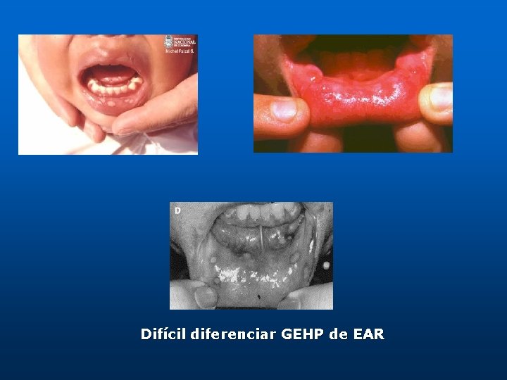 Difícil diferenciar GEHP de EAR 