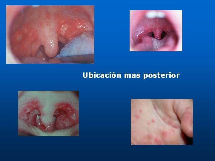 Ubicación mas posterior 