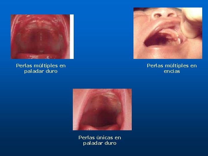 Perlas múltiples en paladar duro Perlas múltiples en encías Perlas únicas en paladar duro