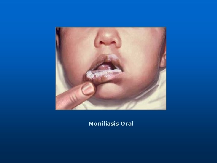 Moniliasis Oral 