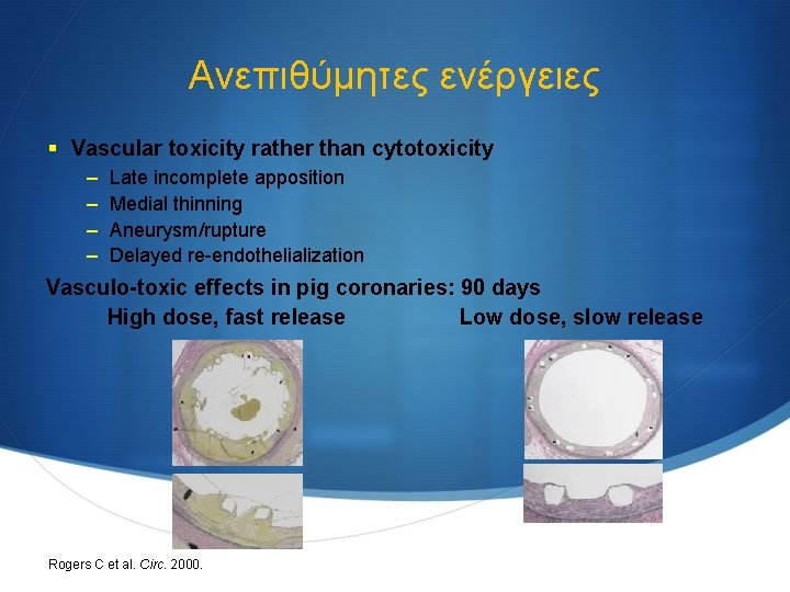 Ανεπιθύμητες ενέργειες § Vascular toxicity rather than cytotoxicity – – Late incomplete apposition Medial