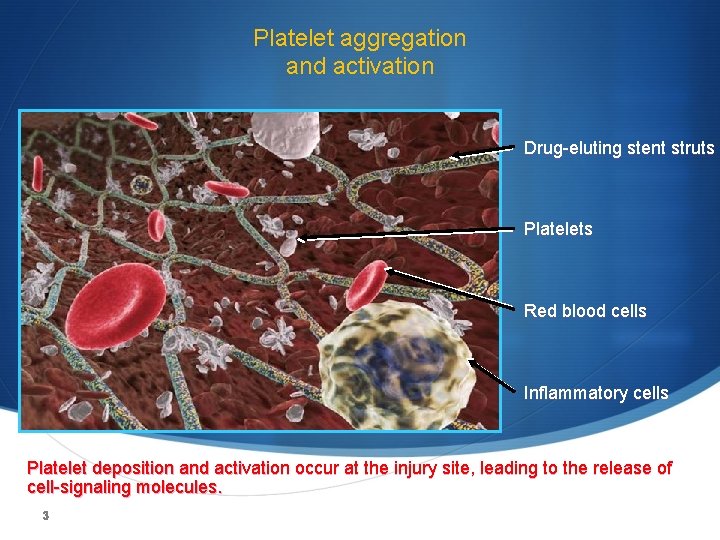 Platelet aggregation and activation Drug-eluting stent struts Platelets Red blood cells Inflammatory cells Platelet