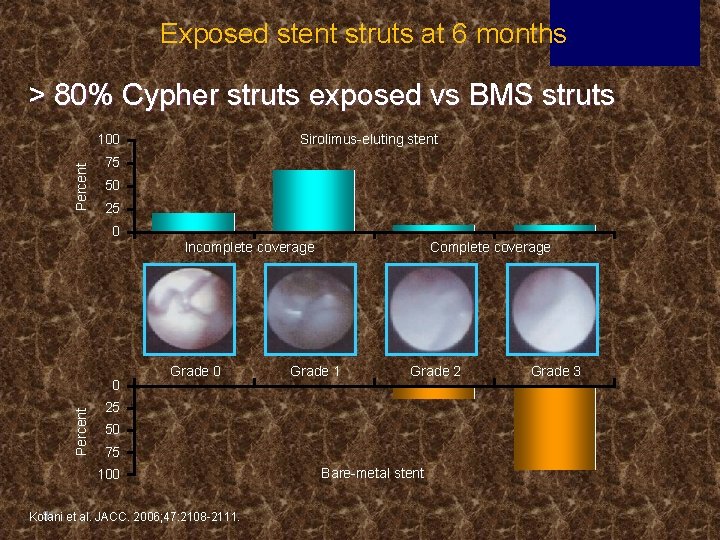 Exposed stent struts at 6 months > 80% Cypher struts exposed vs BMS struts