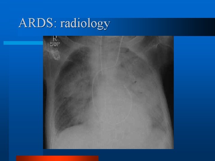 ARDS: radiology 