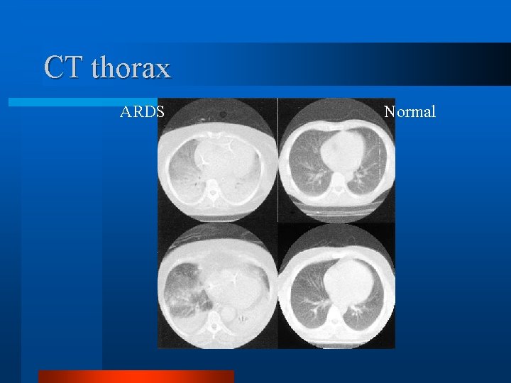 CT thorax ARDS Normal 