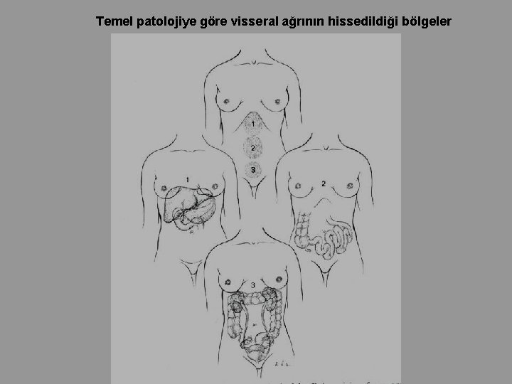 Temel patolojiye göre visseral ağrının hissedildiği bölgeler Temel patolojiye göre visseral ağrının hissedildiği bölgeler