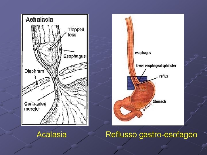 Acalasia Reflusso gastro-esofageo 