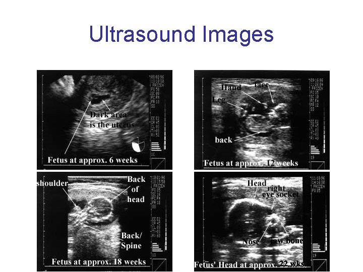 Ultrasound Images Ultrasound Images