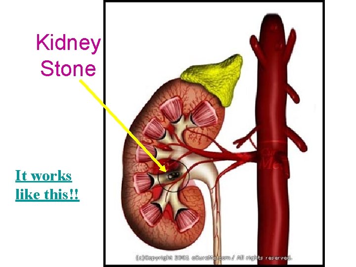 Kidney Stone It works like this!! Kidney Stone It works like this!!
