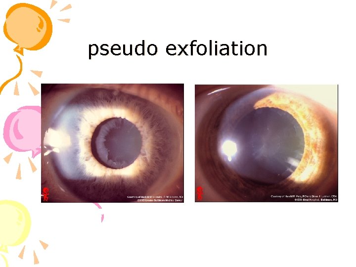 pseudo exfoliation pseudo exfoliation