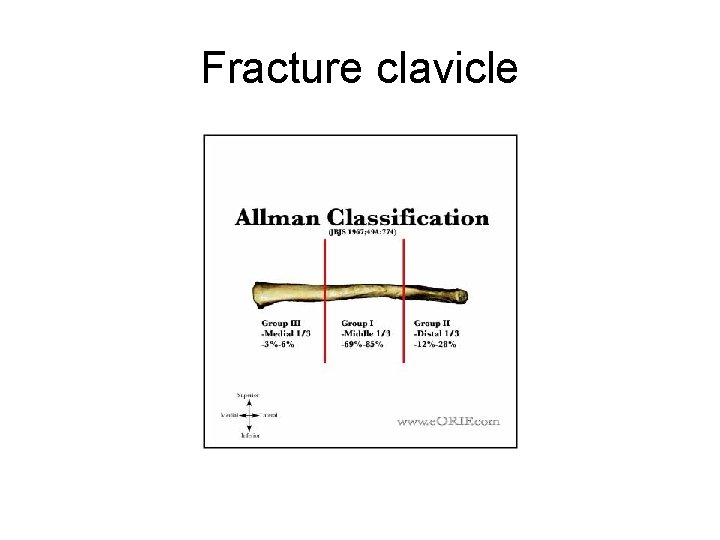 Fracture clavicle 