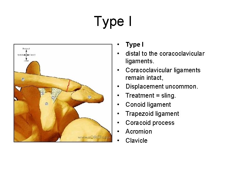 Type I • distal to the coracoclavicular ligaments. • Coracoclavicular ligaments remain intact, •