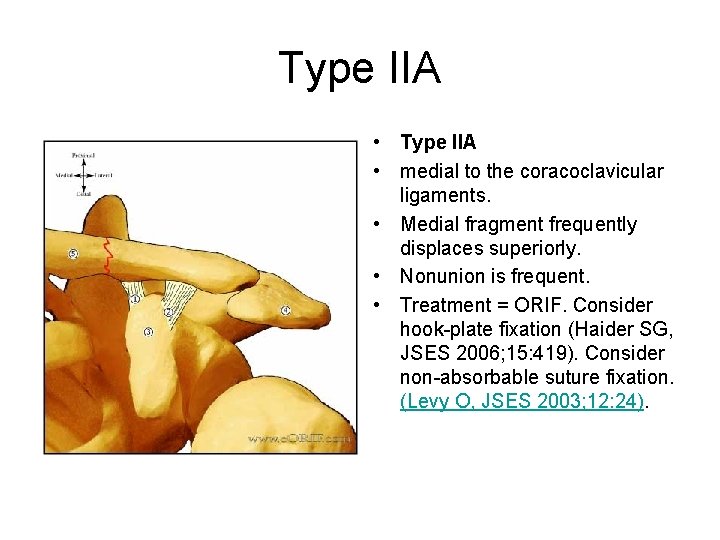 Type IIA • medial to the coracoclavicular ligaments. • Medial fragment frequently displaces superiorly.