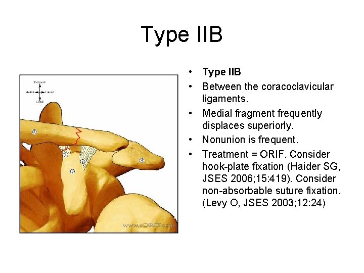 Type IIB • Between the coracoclavicular ligaments. • Medial fragment frequently displaces superiorly. •