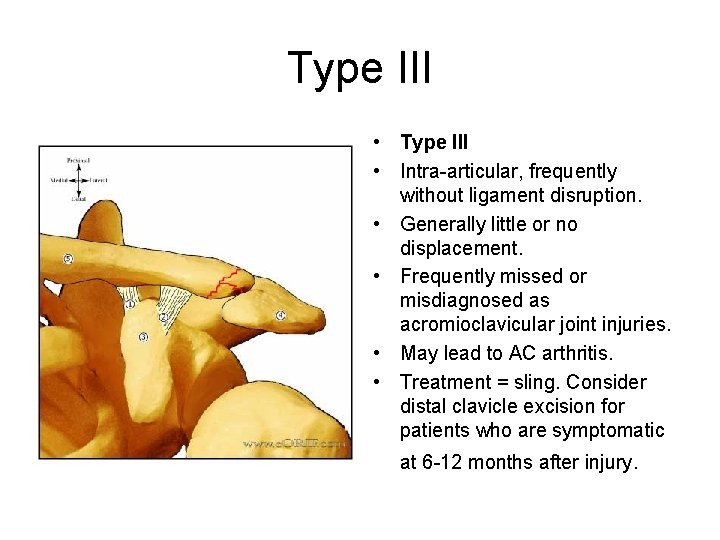 Type III • Intra-articular, frequently without ligament disruption. • Generally little or no displacement.