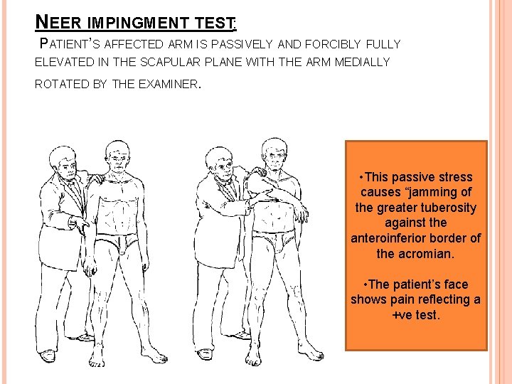 NEER IMPINGMENT TEST: PATIENT’S AFFECTED ARM IS PASSIVELY AND FORCIBLY FULLY ELEVATED IN THE