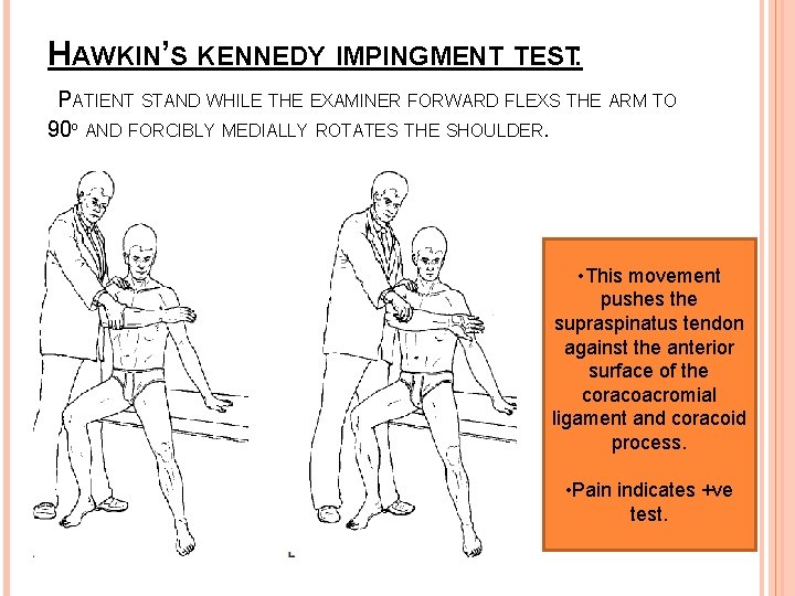 HAWKIN’S KENNEDY IMPINGMENT TEST: PATIENT STAND WHILE THE EXAMINER FORWARD FLEXS THE ARM TO