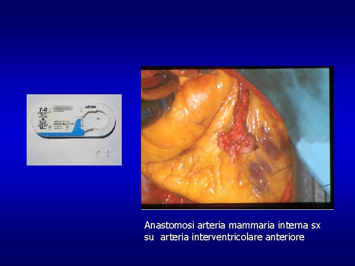 Anastomosi arteria mammaria interna sx su arteria interventricolare anteriore 