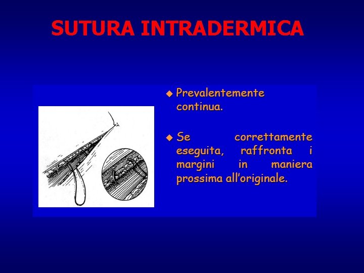 SUTURA INTRADERMICA 