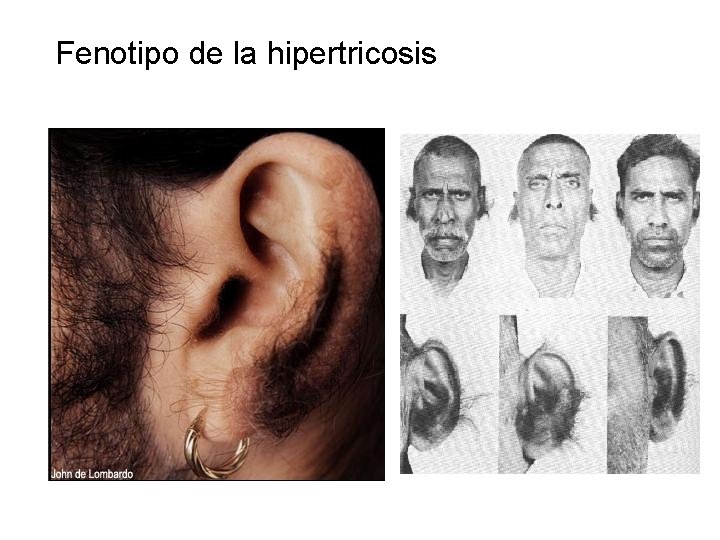 Fenotipo de la hipertricosis 