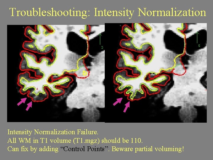 Troubleshooting: Intensity Normalization Failure. All WM in T 1 volume (T 1. mgz) should