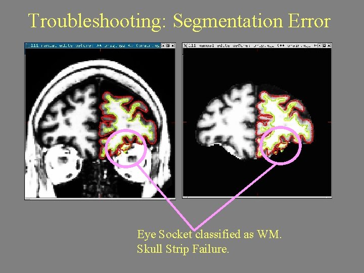 Troubleshooting: Segmentation Error Eye Socket classified as WM. Skull Strip Failure. 