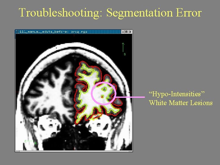 Troubleshooting: Segmentation Error “Hypo-Intensities” White Matter Lesions 
