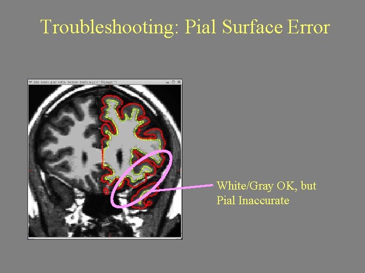 Troubleshooting: Pial Surface Error White/Gray OK, but Pial Inaccurate 