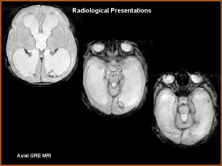 Radiological Presentations Axial GRE MRI 