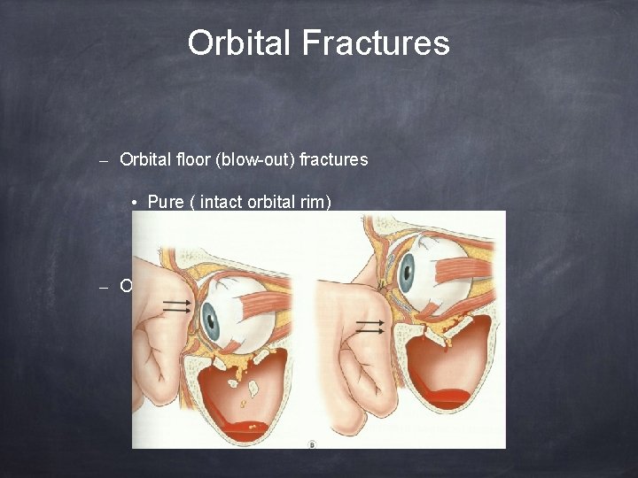 Orbital Fractures – Orbital floor (blow-out) fractures • Pure ( intact orbital rim) •