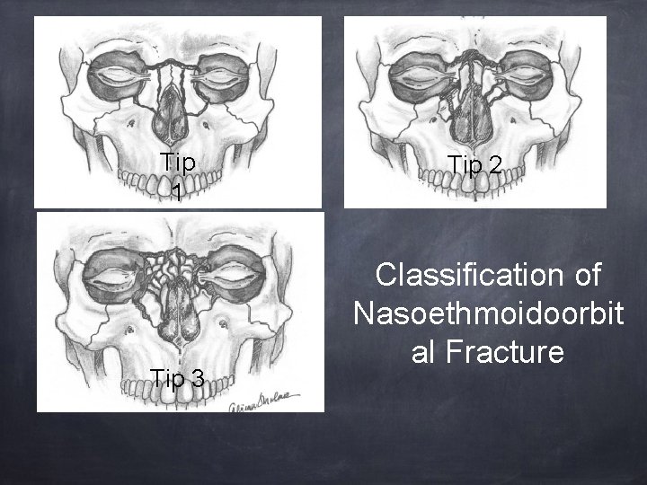 Tip 1 Tip 3 Tip 2 Classification of Nasoethmoidoorbit al Fracture 