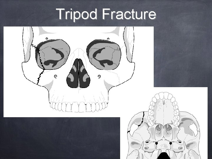 Tripod Fracture 