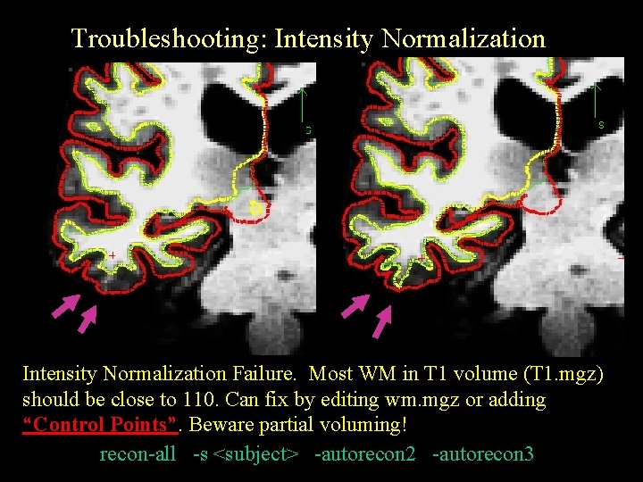 Troubleshooting: Intensity Normalization Failure. Most WM in T 1 volume (T 1. mgz) should
