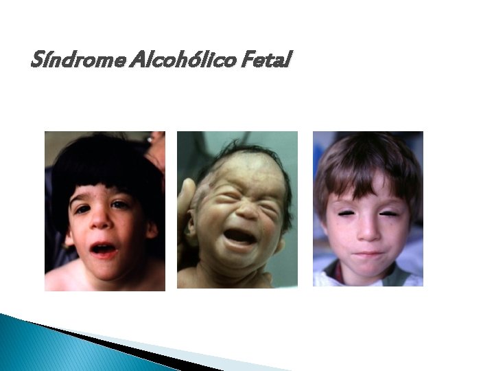 Síndrome Alcohólico Fetal 