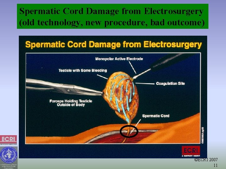 Spermatic Cord Damage from Electrosurgery (old technology, new procedure, bad outcome) ©ECRI 2007 11