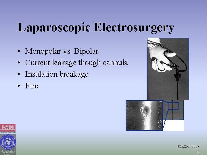 Laparoscopic Electrosurgery • • Monopolar vs. Bipolar Current leakage though cannula Insulation breakage Fire