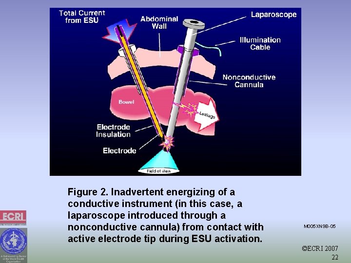 Figure 2. Inadvertent energizing of a conductive instrument (in this case, a laparoscope introduced