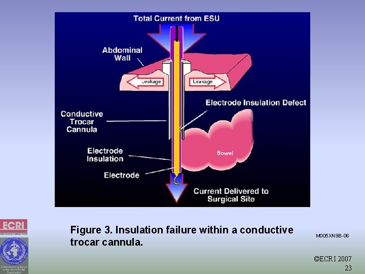 Figure 3. Insulation failure within a conductive trocar cannula. M 005 XN 9 B-06