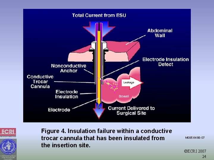 Figure 4. Insulation failure within a conductive trocar cannula that has been insulated from