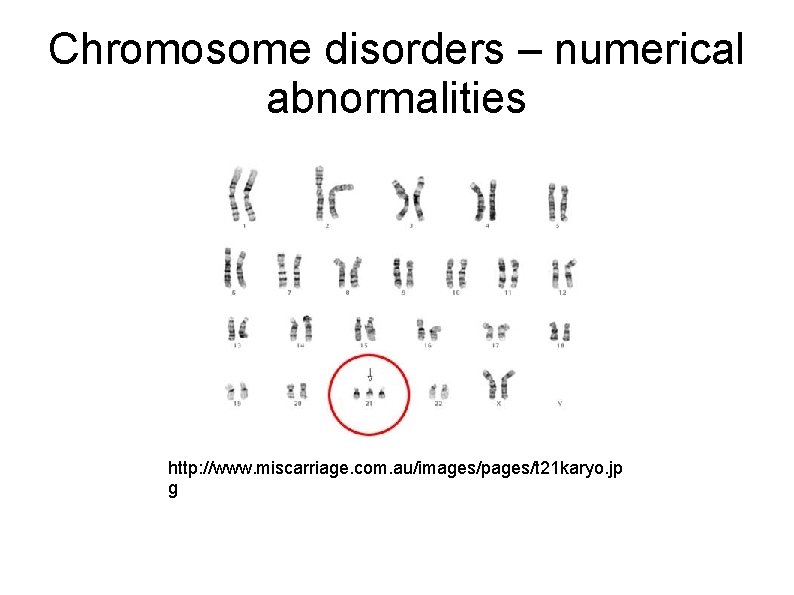 Chromosome disorders – numerical abnormalities http: //www. miscarriage. com. au/images/pages/t 21 karyo. jp g